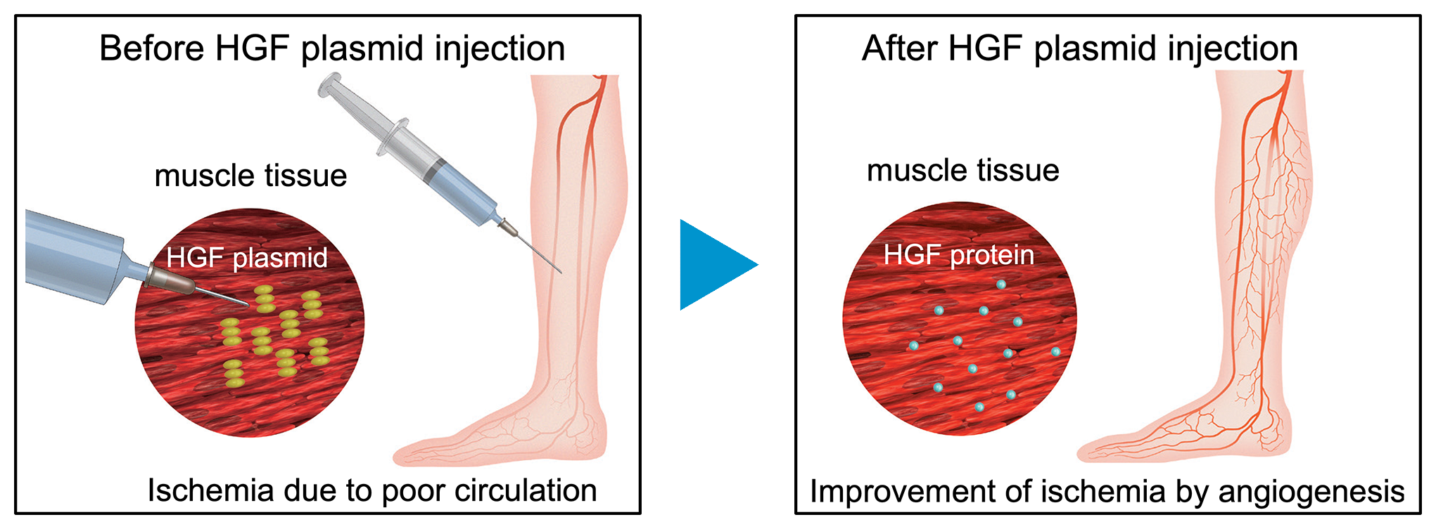 HGF gene therapy